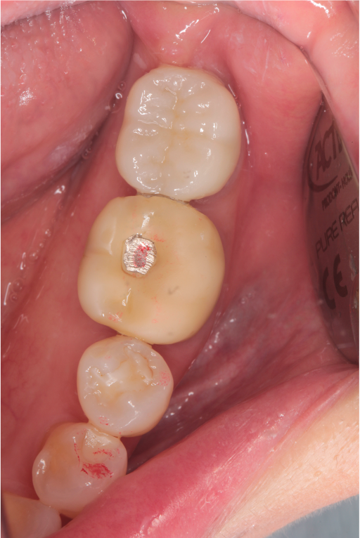 53歳女性「噛むと痛い」「歯がしみる」歯髄炎になった歯を根管治療しセラミッククラウンで機能回復したケース | 市ヶ谷・歯医者