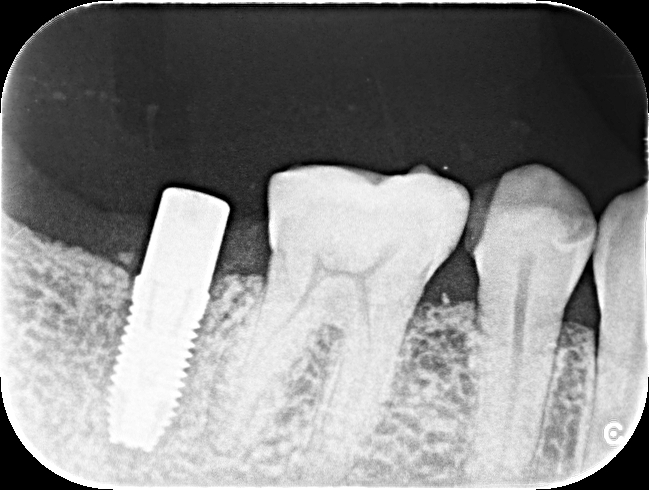 50歳女性　歯根破折した歯を抜歯しインプラントで審美修復したケース | 市ヶ谷・歯医者