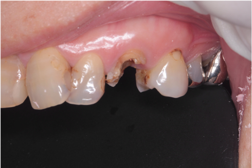 52歳女性「前歯を綺麗にしたい」かけた犬歯をセラミックで審美修復したケース | 市ヶ谷・歯医者
