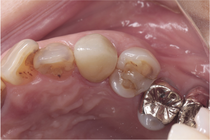 52歳女性「前歯を綺麗にしたい」かけた犬歯をセラミックで審美修復したケース | 市ヶ谷・歯医者