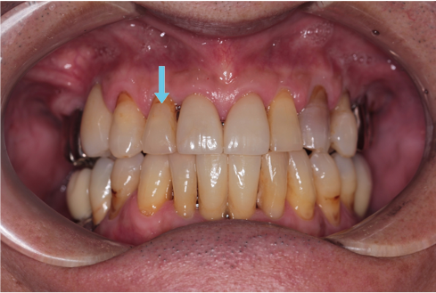 歯髄炎の歯を根管治療を施しセラミック審美修復したケース | 市ヶ谷・歯医者