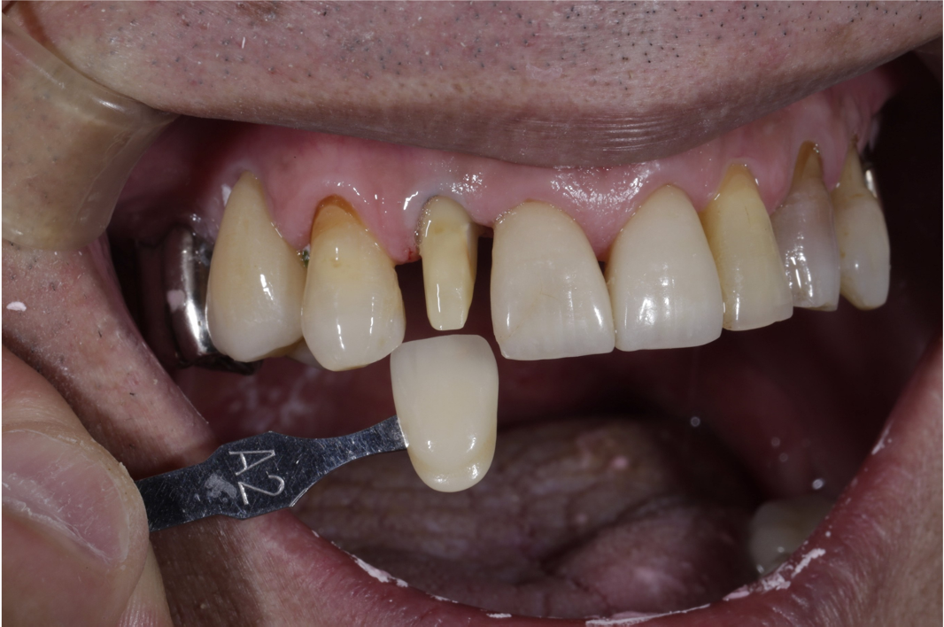 歯髄炎の歯を根管治療を施しセラミック審美修復したケース | 市ヶ谷・歯医者