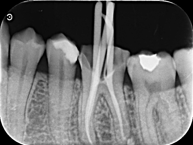 50代女性「歯を噛むと痛い、しみる」歯根膜炎になった歯を根管治療しセラミッククラウンで機能回復したケース | 市ヶ谷・歯医者