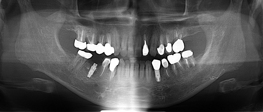 50代男性「噛むと痛い」 ⻭根破折した⻭を抜⻭しインプラントで治療した症例 | 市ヶ谷・歯医者
