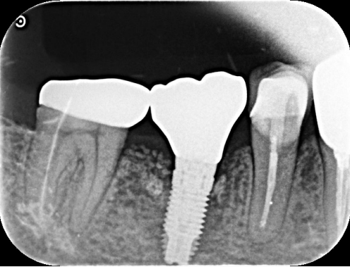 50代男性「噛むと痛い」 ⻭根破折した⻭を抜⻭しインプラントで治療した症例 | 市ヶ谷・歯医者