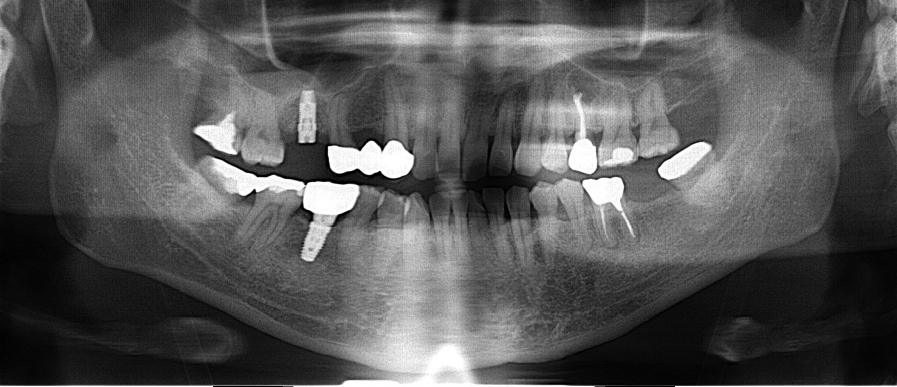 40代男性「⻭ぐきが腫れてきた」⻭根破折した⻭を抜⻭しインプラントで 治療した症例 | 市ヶ谷・歯医者