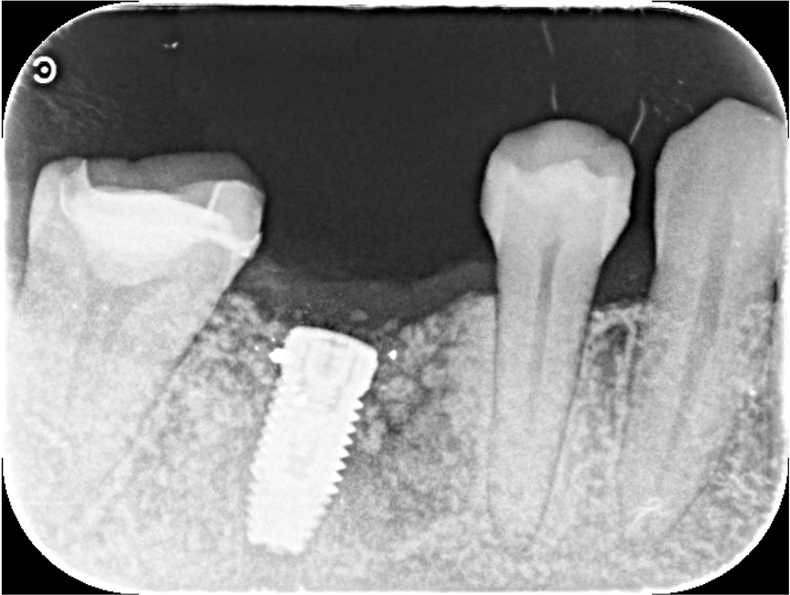 50代女性「インプラントを入れたい」  他院で抜歯した部位をインプラントで審美修復したケース | 市ヶ谷・歯医者