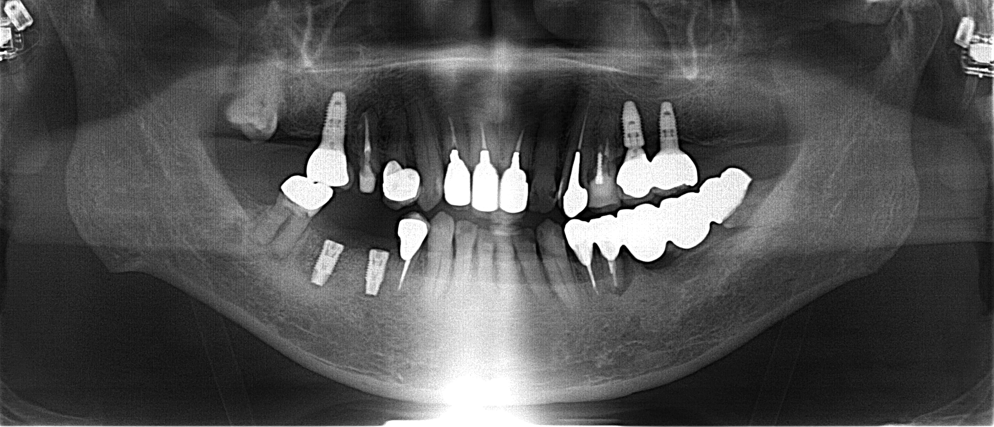 70代男性「インプラントを入れて欲しい」 歯根破折した歯を抜歯しインプラントで審美修復したケース | 市ヶ谷・歯医者