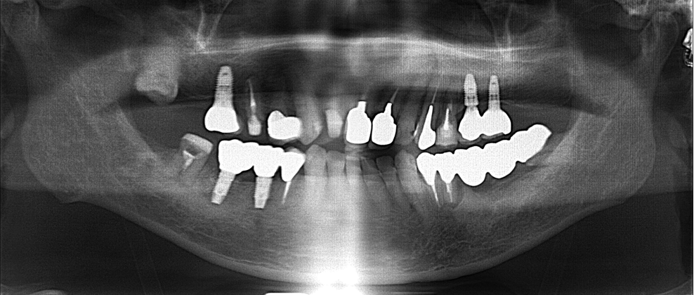 70代男性「インプラントを入れて欲しい」 歯根破折した歯を抜歯しインプラントで審美修復したケース | 市ヶ谷・歯医者