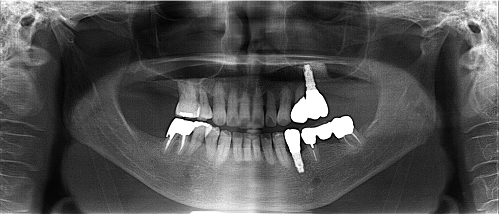 60代女性「歯肉が腫れ、歯が揺れて噛めない」 歯槽膿漏の歯を抜歯しインプラントで審美修復したケース | 市ヶ谷・歯医者