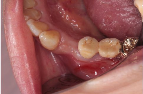 60代女性「歯肉が腫れ、歯が揺れて噛めない」 歯槽膿漏の歯を抜歯しインプラントで審美修復したケース | 市ヶ谷・歯医者