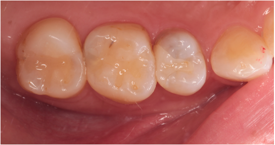 20代女性「歯がしみる」隣接の深い虫歯の神経を残しつつセラミックで審美修復したケース | 市ヶ谷・歯医者