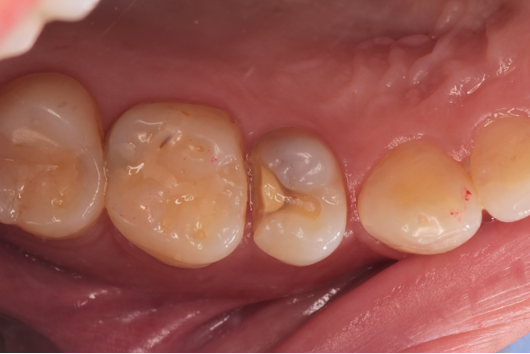 20代女性「歯がしみる」隣接の深い虫歯の神経を残しつつセラミックで審美修復したケース | 市ヶ谷・歯医者