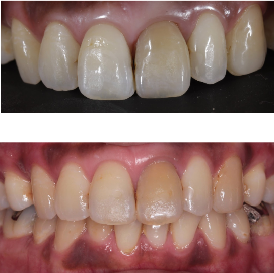 30代女性「歯の変色を治したい」変色した歯をセラミックで審美修復した症例 | 市ヶ谷・歯医者