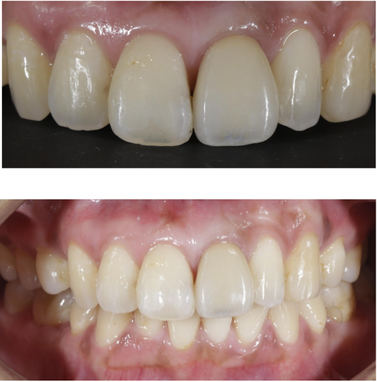 30代女性「歯の変色を治したい」変色した歯をセラミックで審美修復した症例 | 市ヶ谷・歯医者