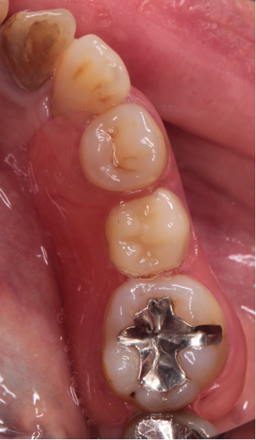 60代女性「入れ歯が厚くてかみづらい、インプラントは避けたい」 臼歯1歯欠損をエステティックデンチャーで審美回復した症例 | 市ヶ谷・歯医者