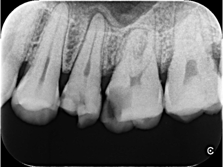 20代男性「歯が痛い」重度のう蝕の歯をセラミックで審美修復したケース | 市ヶ谷・歯医者