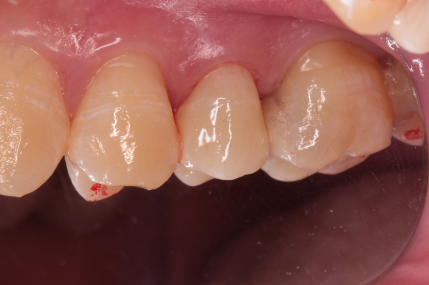 20代男性「歯が痛い」重度のう蝕の歯をセラミックで審美修復したケース | 市ヶ谷・歯医者