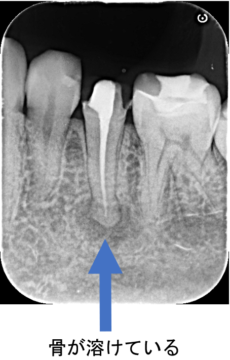 30代女性「歯がうずく」根管治療を行いジルコニアで咬合回復させたケース | 市ヶ谷・歯医者