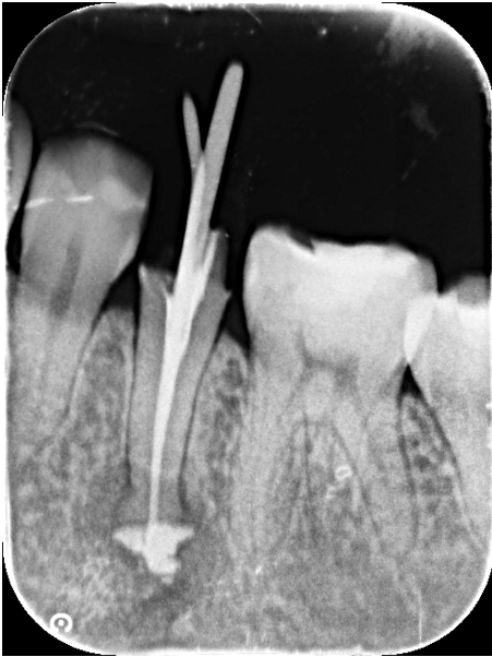 30代女性「歯がうずく」根管治療を行いジルコニアで咬合回復させたケース | 市ヶ谷・歯医者