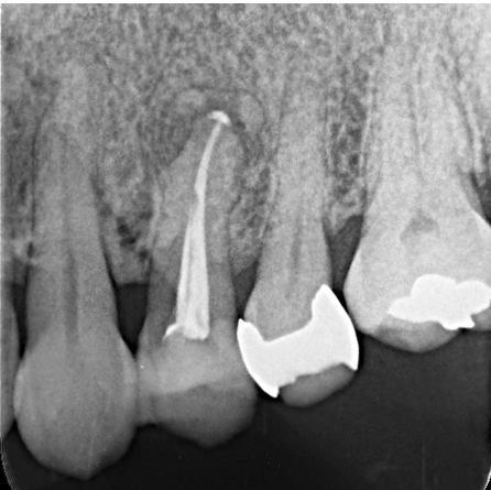 60代女性「歯がうずく、歯茎が腫れている」難治性の歯を根管治療を行いジルコニアで咬合回復させたケース | 市ヶ谷・歯医者