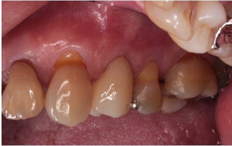 60代女性「歯がうずく、歯茎が腫れている」難治性の歯を根管治療を行いジルコニアで咬合回復させたケース | 市ヶ谷・歯医者