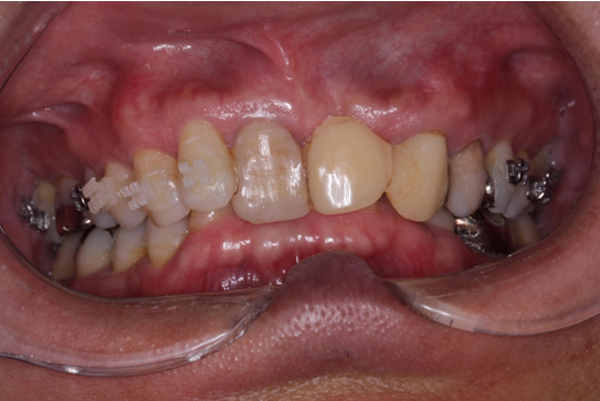 50代男性「治療の続きをしたい、前歯をきれいに治したい」矯正治療後に前歯をセラミック治療で修復して審美を回復した症例 | 市ヶ谷・歯医者