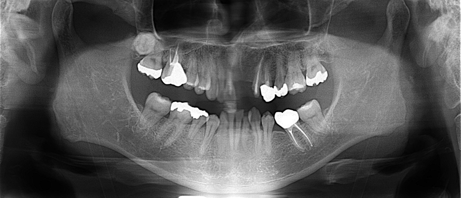 50代男性「治療の続きをしたい、前歯をきれいに治したい」矯正治療後に前歯をセラミック治療で修復して審美を回復した症例 | 市ヶ谷・歯医者