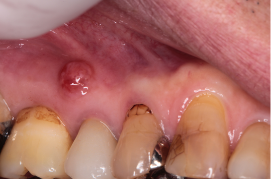 60代男性「歯茎の腫れが長く引かない」歯を根切しMTAで治癒させた症例 | 市ヶ谷・歯医者
