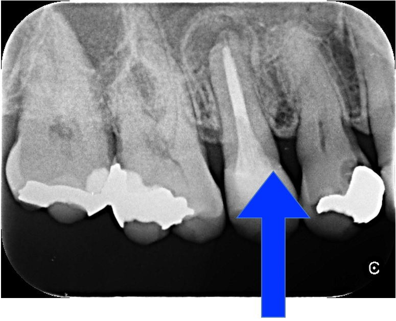 60代男性「歯茎の腫れが長く引かない」歯を根切しMTAで治癒させた症例 | 市ヶ谷・歯医者