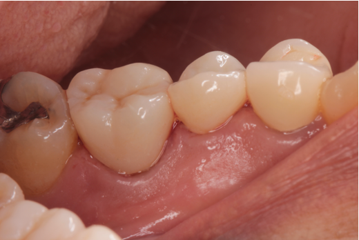 60代女性「見える部分の銀歯を綺麗にしたい」適合不良の銀歯をセラミックで審美修復したケース | 市ヶ谷・歯医者