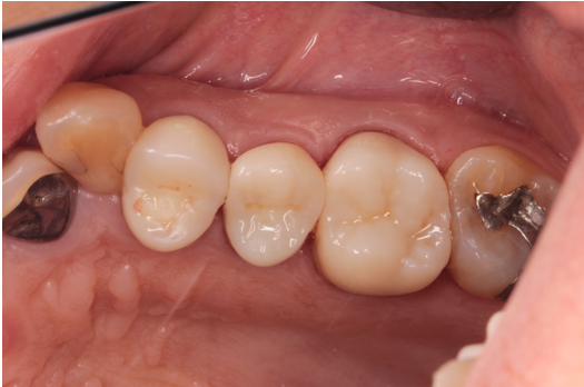 60代女性「見える部分の銀歯を綺麗にしたい」適合不良の銀歯をセラミックで審美修復したケース | 市ヶ谷・歯医者