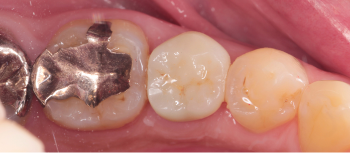 50代男性「歯の間に物が詰まる」破折したセラミックをジルコニアで審美修復したケース | 市ヶ谷・歯医者