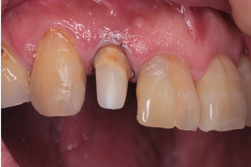 50代男性「歯がズキズキ痛い」根管治療不良の歯をMTAとセラミックで審美修復したケース | 市ヶ谷・歯医者