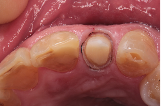 50代男性「歯がズキズキ痛い」根管治療不良の歯をMTAとセラミックで審美修復したケース | 市ヶ谷・歯医者