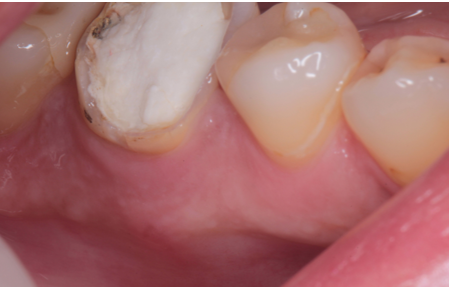40代女性「他院にて治療を終了したが歯茎が腫れてきた」長く歯茎の腫れが引かない歯をMTAによる根管治療で治癒したケース | 市ヶ谷・歯医者
