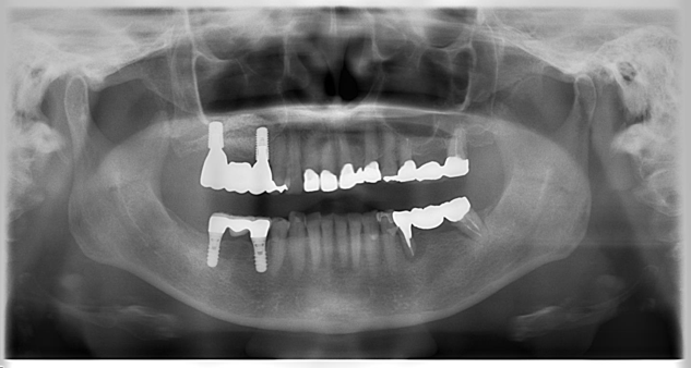 60代女性「抜歯した部分にインプラントを入れたい」サイナスリフトと骨誘導再生法（GBR）を用いてインプラントブリッジで審美修復したケース | 市ヶ谷・歯医者