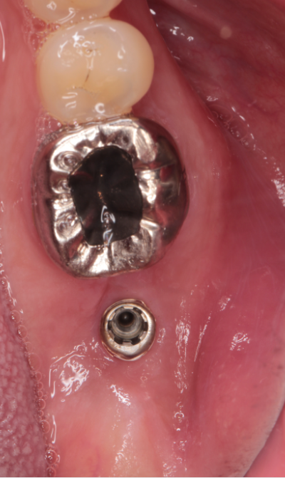 40代男性「噛むと違和感がある、痛い」割れた歯を抜歯後、インプラントで原状回復した症例 | 市ヶ谷・歯医者