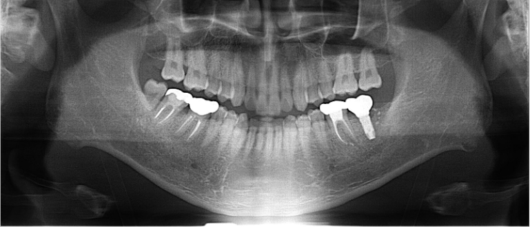 40代男性「噛むと違和感がある、痛い」割れた歯を抜歯後、インプラントで原状回復した症例 | 市ヶ谷・歯医者