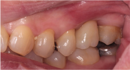 60代女性「歯が取れたので新しく歯を入れたい」保存不可能な歯を抜歯後、骨増加（ソケットリフト）を行いインプラントで審美修復したケース | 市ヶ谷・歯医者