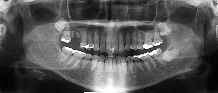 60代女性「歯が取れたので新しく歯を入れたい」保存不可能な歯を抜歯後、骨増加（ソケットリフト）を行いインプラントで審美修復したケース | 市ヶ谷・歯医者