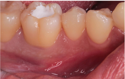 30代男性「歯茎が腫れてきた」神経が壊死した歯を根管治療で治癒したケース | 市ヶ谷・歯医者