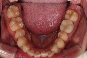 当院でメインテナンスをされて健康な歯を維持されている患者さんの例 | 市ヶ谷・歯医者