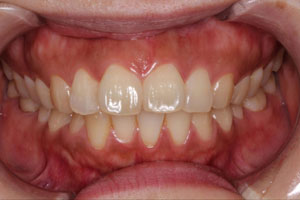 当院でメインテナンスをされて健康な歯を維持されている患者さんの例 | 市ヶ谷・歯医者