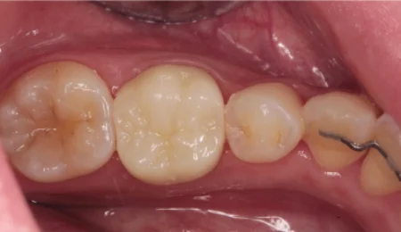 20代女性「治療途中の歯を治したい」根管治療後にジルコニアで被せものを作って噛み合わせを回復したケース | 市ヶ谷・歯医者