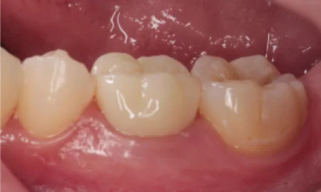 20代女性「治療途中の歯を治したい」根管治療後にジルコニアで被せものを作って噛み合わせを回復したケース | 市ヶ谷・歯医者