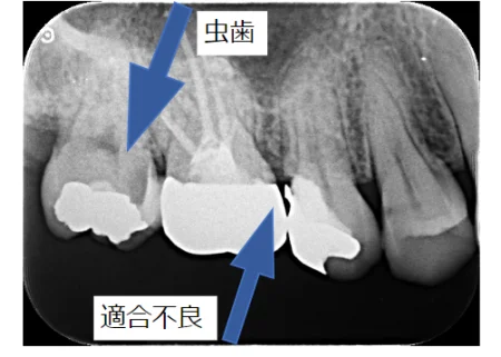 40代女性「歯がしみる気がする」フィットしていなかった詰め物の下にできていた虫歯を取りきり、ゴールドで修復した症例 | 市ヶ谷・歯医者