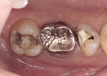 40代女性「歯がしみる気がする」フィットしていなかった詰め物の下にできていた虫歯を取りきり、ゴールドで修復した症例 | 市ヶ谷・歯医者