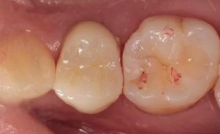 20代女性「治療途中の歯から変な味がする。しっかり治療したい」膿が溜まっていた歯の根っこを治療し、ジルコニアの被せ物で噛めるように治療した症例 | 市ヶ谷・歯医者