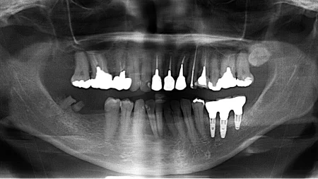 50代女性「インプラントを入れたい」右下の奥歯2本をインプラントで機能的にも審美的にも修復したケース | 市ヶ谷・歯医者